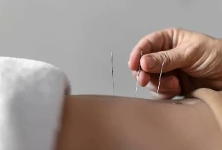 Curso gratuito de Acupuntura